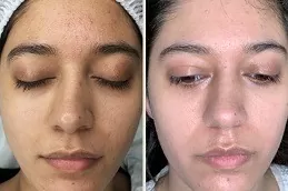Green Peels Treatment Clinic in Abu Dhabi