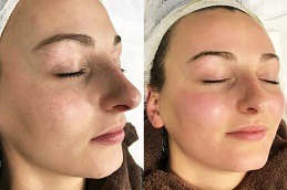 Green Peels Treatment Clinic in Dubai