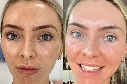 Green Peels Treatment Dubai & Abu Dhabi