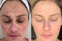 Green Peels Treatment in Dubai & Abu Dhabi