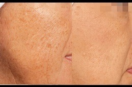 Green Peels Treatment in Dubai