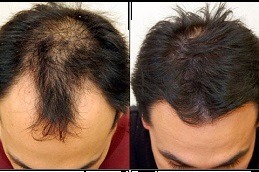 Hair Loss Treatment in Abu Dhabi