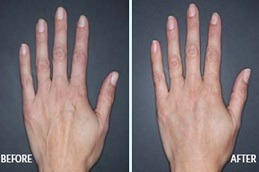 Hand Rejuvenation Abu Dhabi