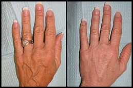 Hand Rejuvenation Clinic Abu Dhabi