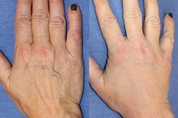 Hand Rejuvenation Dubai & Abu Dhabi