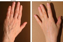 Hand Rejuvenation Dubai