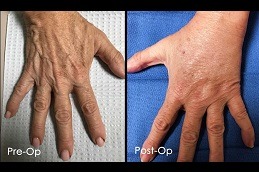 Hand Rejuvenation in Dubai