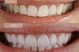 Hollywood Smile Design in Abu Dhabi