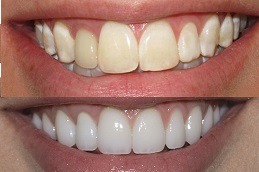 Hollywood Smile Design in Dubai