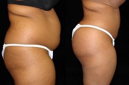 Hydrogel Buttock Injections Cost Dubai