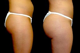 Hydrogel Buttock Injections Cost in Dubai