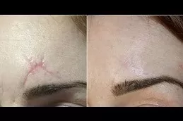 Hypertrophic Scars Treatment Clinic Dubai