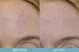 Hypertrophic Scars Treatment Dubai & Abu Dhabi