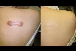 Hypertrophic Scars Treatment Dubai