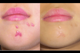 Hypertrophic Scars Treatment in Abu Dhabi
