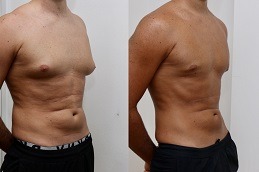 Is Gynecomastia best Covered by Insurance Dubai