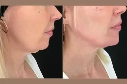 Jawline Treatment in Dubai