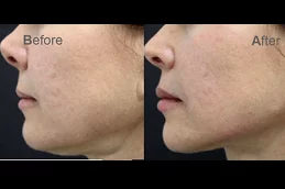 Jawline Treatment Clinic in Dubai