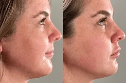 Jawline Treatment Dubai