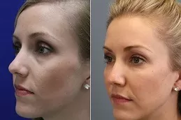 Jawline Treatment 