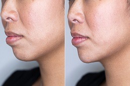 Jawline Treatment in Dubai