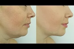 Jawline Treatment Dubai
