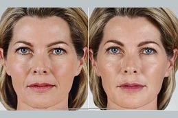 Juvederm Treatment Clinic in Abu Dhabi