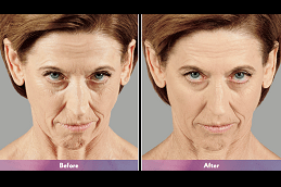 Juvederm Treatment Dubai & Abu Dhabi