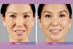 Juvederm Treatment in Abu Dhabi