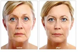 Juvederm Treatment in Dubai & Abu Dhabi
