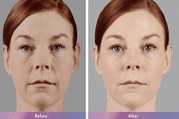 Juvederm Treatment in Dubai