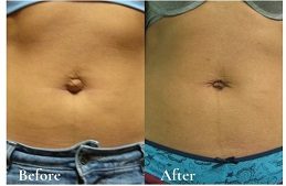 Laparoscopic Surgery Abu Dhabi