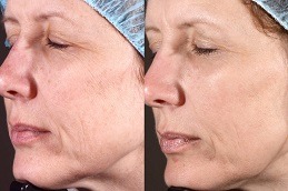 Laser Carbon Peel Clinic Abu Dhabi