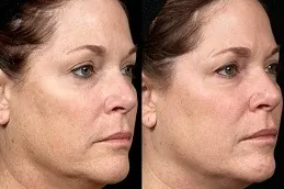 Laser Carbon Peel Clinic in Abu Dhabi