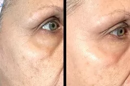 Laser Carbon Peel Clinic in Dubai