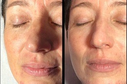 Laser Carbon Peel Dubai & Abu Dhabi