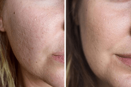 Laser Carbon Peel in Dubai & Abu Dhabi