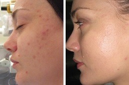 Laser Carbon Peel in Dubai