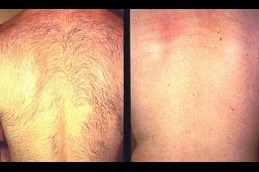 Laser Hair Bleaching Clinic in Dubai