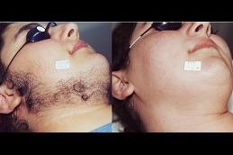Laser Hair Bleaching Clinic Dubai