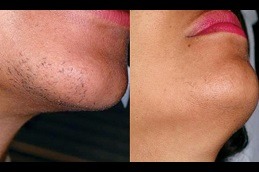 Laser Hair Bleaching Dubai