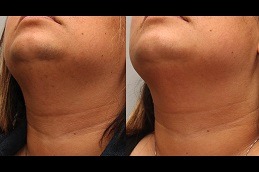 Laser Hair Bleaching in Dubai