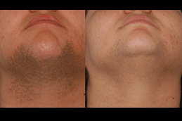 Best Laser Hair Bleaching in Dubai