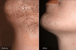 Laser Hair Bleaching