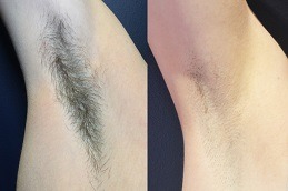 Laser Hyperhidrosis Treatment Clinic Abu Dhabi
