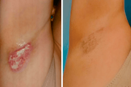 Laser Hyperhidrosis Treatment Clinic in Abu Dhabi
