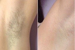 Laser Hyperhidrosis Treatment Clinic in Dubai