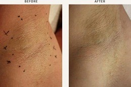 Laser Hyperhidrosis Treatment Clinic in Dubai