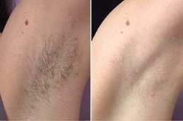 Laser Hyperhidrosis Treatment in Dubai