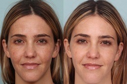 Laser Photo Rejuvenation Abu Dhabi
